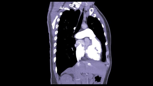 CTA CHEST showing pulmonary embolism  (white arrow ).