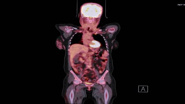 PET CT image of whole body in  Coronal plane. Positron Emission Tomography - Computed Tomography .