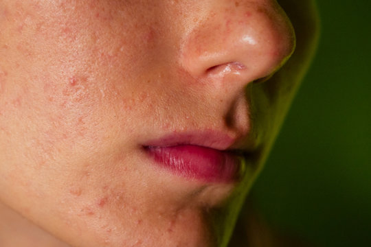 post-acne, scars and red festering pimples on the face of a young woman. concept of skin problems and harmonic failure