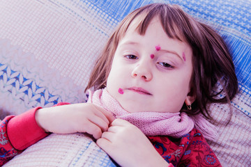 Little cute child girl with red pimples lying in bed at home. Chicken pox concept.