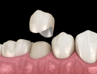 Fototapeta na wymiar Dental crown premolar tooth assembly process. Medically accurate 3D illustration of human teeth treatment