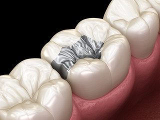 Inlay silver crown fixation over tooth. Medically accurate 3D illustration of human teeth treatment