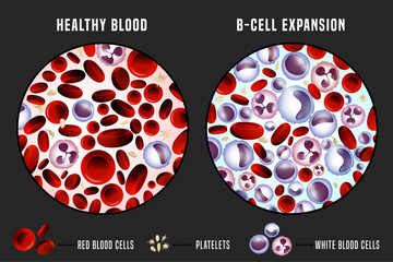 Leukemia Infographic Image