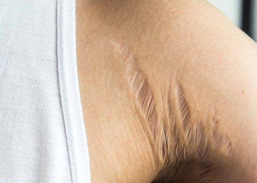 stretch marks on armpit skin area caused by tearing of the dermis layer of the skin (prednisolone's side effect), selective focus