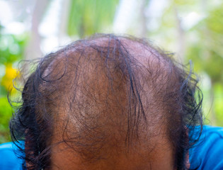 Head lose hair.Close up of head Asian man less hair. Glabrous , Baldness, Photo  lose one's hair and Health concept.