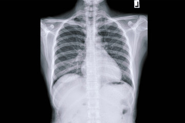 Chest radiograph, Chest x-ray, CXR of COPD patients.