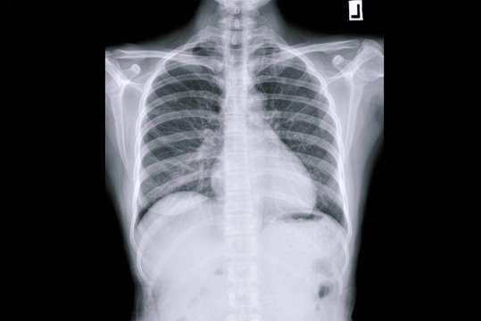 Chest Radiograph, Chest X-ray, CXR Of COPD Patients.