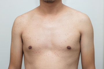 acne bacteria on male body skincare