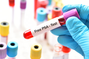 Blood sample for free PSA test, diagnosis for prostate cancer