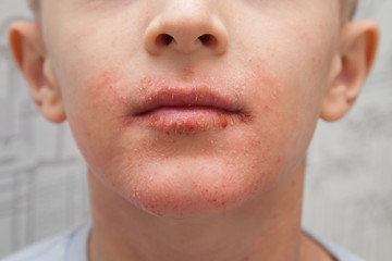 Atopic skin on the boy face. Human skin, presenting an allergic reaction, allergic rash on face and...