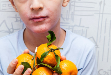 A young boy with a red rash on his cheeks and lips holds an oranges in his hands. Healh care and...