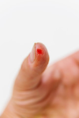 Wound on the finger. Scarlet blood on the thumb. An ointment-treated finger after a cut. The right...