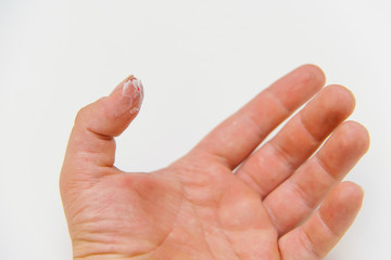 Wound on the finger. Scarlet blood on the thumb. An ointment-treated finger after a cut. The right...