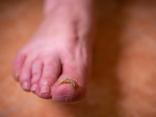 Bad toenail. Pain and trauma