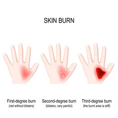 Degree burns of skin. step of burn.