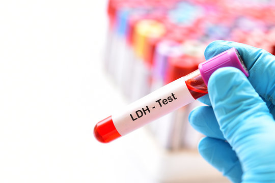 Blood sample tube for lactate dehydrogenase or LDH test
