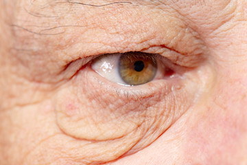Eye bags and wrinkles under the eyes of an elderly caucasian man