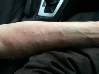 Hives on an arm, the result of an allergy  needle prick test.