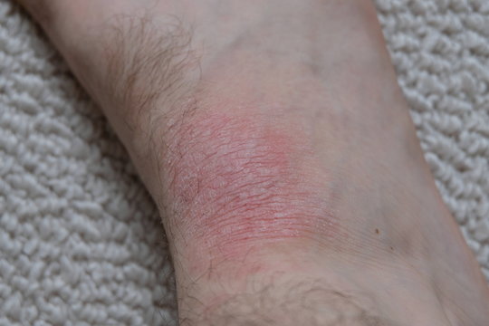 A man with mild Eczema. Dry skin on the foot.