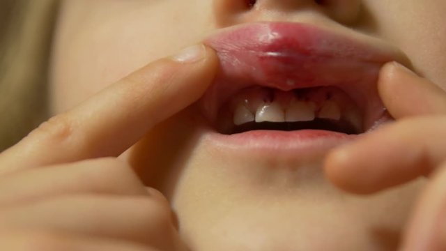 The Broken Lips Mouth