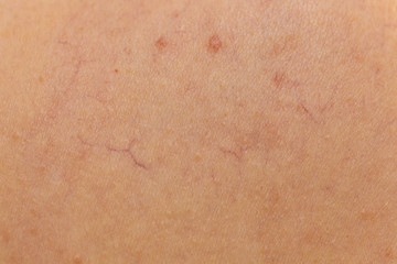 Ski with dilated capillaries ad red spots