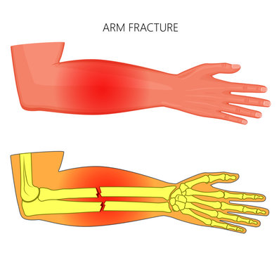 Vector illustration of a human arm with shaft fracture injury of ulnar and radius tubular bones and area of pain.  For advertising, medical publications, use on package of medicinal products