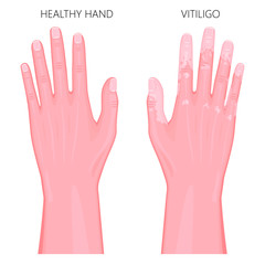 Vector illustration of a healthy hand and a hand with vitiligo, loss of skin color. Dorsal view. For advertising, medical publications