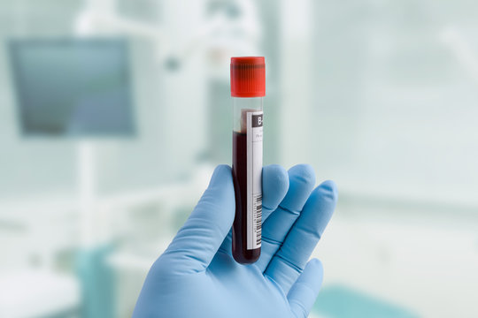 Medizinerhand mit blauem Handschuh hält im Labor eine Blutprobe