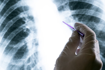 A doctor or laboratory assistant in a white glove is holding a pointer over a chest x-ray. Concept of tuberculosis disease prevention or medical training. Day of the radiologist or phthisator.