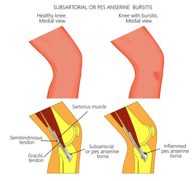 Vector illustration of a healthy knee and unhealthy knee with Subsartorial or pes anserine bursitis or breaststroke swimmer knee. Anatomy of human knee joint, external view and medial or side view.