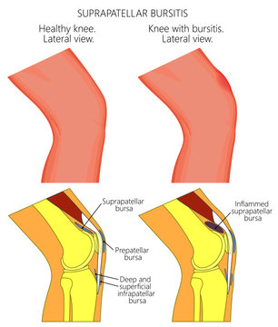 Vector illustration of a healthy knee and unhealthy knee with suprapatellar bursitis. Anatomy of human knee joint, lateral or side view.