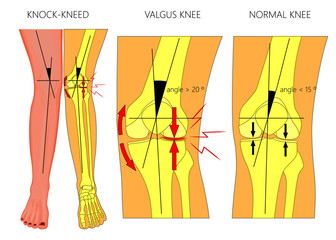 Vector illustration diagram. Shapes of human legs. Normal and curved legs. Knock knees.  Genu valgum and genu varum.  For advertising, medical publications - obrazy, fototapety, plakaty