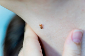 a birthmark or a mole on a woman skin