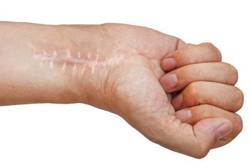 Scar with stitches on the wrist after surgery. Fracture of the bones of the hands in fist isolated on white background