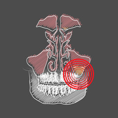 Stylized hatching of the Odontogenic sinusitis. Inflammation of the maxillary sinuses due to a disease of the roots of the tooth with a point of pain and inflammation. - 240181319