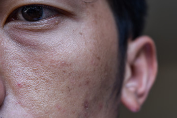close up wide pores skin on oily face of asia man