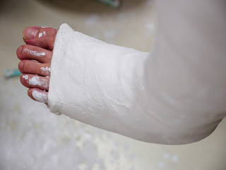 Closeup detail of the toes of a patient with a newly set plaster bandage cast of the leg for a tibial bone fracture. Healthcare and orthopedic surgery.
