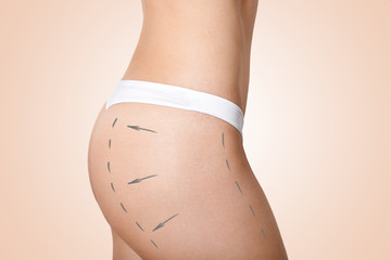 Cropped image of slim woman wears white pants, has marked arrows on hip, prepares for cellulite removal or plastic surgery, isolated over beige background. Slimming, liposuction, fat loosing concept