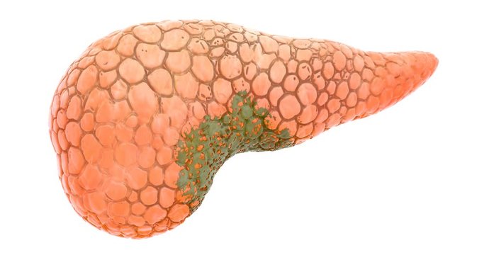 Disease spread on pancreas, 3d animation. 3D rendering isolated on white background