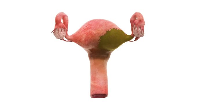 Disease spread on uterus, 3d animation. 3D rendering isolated on white background