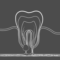 dental disease linear icon. Medical illustration of tooth root inflammation, tooth root cyst, pulpitis.