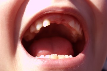 Mouth without teeth. Baby teeth. Teeth fell out.