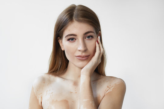 Beauty standards, health, skin conditions, dermatology and auto immune disease concept. Cute attractive young European woman with pale white vitiligo patches, holding hand on her face and smiling
