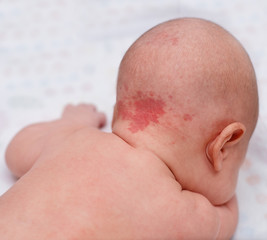 Hemangioma, benign tumor on the back of the head in an infant.