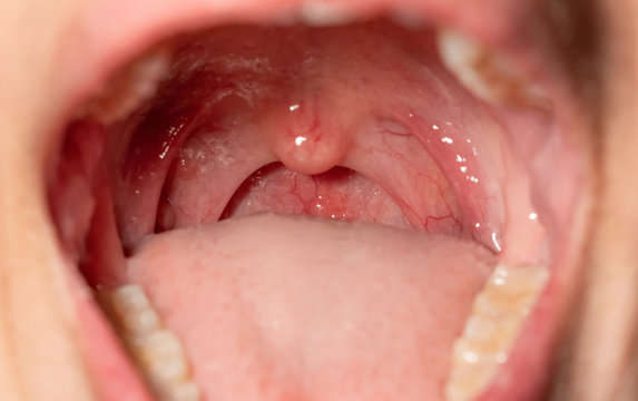 Sore throat with throat swollen. Closeup open mouth with posterior pharyngeal wall swelling and uvula and tonsil. Influenza follicles in the posterior pharyngeal wall. Macro shot of lymphoid follicles