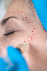 PRP Face Injecting Treatment.  Cosmetic Anti-Aging Platelet Rich Plasma Treatment