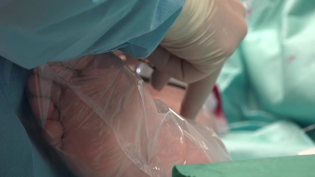 Endovenous laser ablation (EVLA) is a commonly used and very effective minimally invasive therapy to manage leg varicosities.