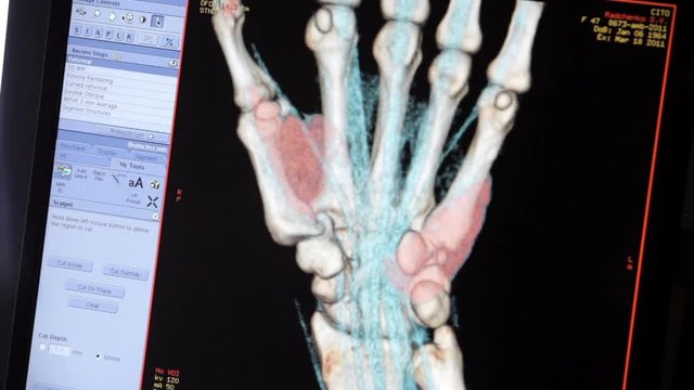 Pictures of the bone scan on the monitor.