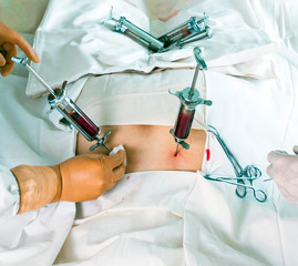 bone marrow transplant operation