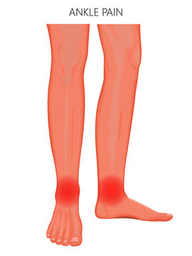Vector illustration of a human legs (anterior and medial view) with ankle joint pain or injury. For advertising, medical (health care) publications